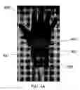 Fig. 05 - Medical electrode glove with partially insulating layer