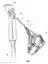 Fig. 02 - Buckle for connecting a wrist strap to the handgrip of a pole for use in sporting activities
