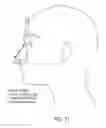 Fig. 45 - Ergonomic and adjustable respiratory mask assembly with headgear assembly
