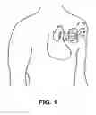 Fig. 02 - Medical device packaging system