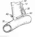 Fig. 01 - Anastomosis Stapler