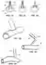 Fig. 08 - Anastomosis Stapler