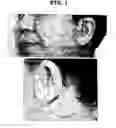 Fig. 02 - Digital hearing aid enhancing directional performance