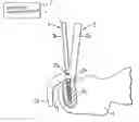 Fig. 01 - Device for fixing a reference element