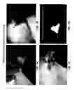 Fig. 02 - Intraoperative determination of nerve location