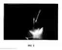 Fig. 03 - Intraoperative determination of nerve location