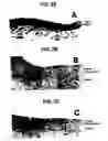 Fig. 03 - Method for treating atherosclerosis or restenosis using microtubule stabilizing agent