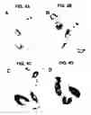 Fig. 05 - Method for treating atherosclerosis or restenosis using microtubule stabilizing agent