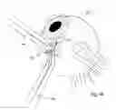 Fig. 11 - Intraocular pressure sensor and method of use