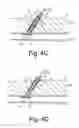 Fig. 06 - Apparatus and methods for sealing a vascular puncture