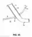 Fig. 08 - INSTRUMENT ASSISTED ABDOMINAL ACCESS