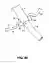 Fig. 16 - INSTRUMENT ASSISTED ABDOMINAL ACCESS