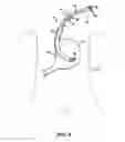 Fig. 20 - INSTRUMENT ASSISTED ABDOMINAL ACCESS