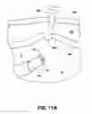 Fig. 23 - INSTRUMENT ASSISTED ABDOMINAL ACCESS