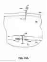 Fig. 30 - INSTRUMENT ASSISTED ABDOMINAL ACCESS