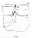 Fig. 32 - INSTRUMENT ASSISTED ABDOMINAL ACCESS