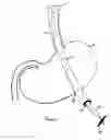 Fig. 35 - INSTRUMENT ASSISTED ABDOMINAL ACCESS