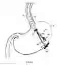 Fig. 37 - INSTRUMENT ASSISTED ABDOMINAL ACCESS