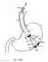 Fig. 40 - INSTRUMENT ASSISTED ABDOMINAL ACCESS