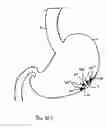 Fig. 41 - INSTRUMENT ASSISTED ABDOMINAL ACCESS
