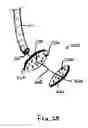 Fig. 45 - INSTRUMENT ASSISTED ABDOMINAL ACCESS
