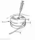 Fig. 01 - Implantable drug delivery pump