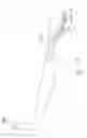 Fig. 04 - Endovenous laser treatment for varicose veins