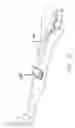 Fig. 06 - Endovenous laser treatment for varicose veins