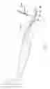 Fig. 08 - Endovenous laser treatment for varicose veins