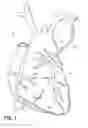 Fig. 02 - Electrosurgical methods and apparatus for making precise incisions in body vessels