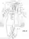 Fig. 06 - Electrosurgical methods and apparatus for making precise incisions in body vessels