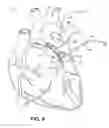 Fig. 07 - Electrosurgical methods and apparatus for making precise incisions in body vessels