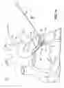Fig. 09 - Electrosurgical methods and apparatus for making precise incisions in body vessels