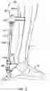 Fig. 08 - Orthopaedic joint, device and associated method