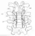 Fig. 01 - Method and apparatus for spinal fixation