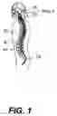 Fig. 02 - Apparatus and method for spine fixation