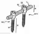 Fig. 01 - Method and apparatus for flexible fixation of a spine