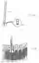 Fig. 20 - Method and apparatus for flexible fixation of a spine