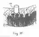 Fig. 23 - Method and apparatus for flexible fixation of a spine