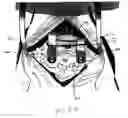 Fig. 06 - Occipitocervical plate