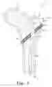 Fig. 08 - Intramedullary nail