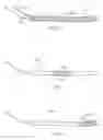Fig. 09 - Inflatable Device for Restoring Anatomy of Fractured Bone