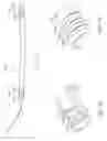 Fig. 10 - Inflatable Device for Restoring Anatomy of Fractured Bone