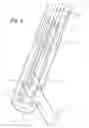 Fig. 05 - Mechanical cavity-creation surgical device and methods and kits for using such devices