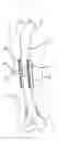 Fig. 01 - Bone regeneration device for bones, and method of use