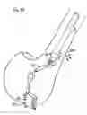 Fig. 15 - Method of resecting bone