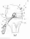 Fig. 06 - Device for forming a drill hole in bone