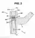 Fig. 04 - Assembly tool for modular implants, kit and associated method