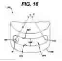 Fig. 16 - Assembly tool for modular implants, kit and associated method