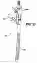 Fig. 36 - Assembly tool for modular implants, kit and associated method